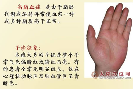 高脂血症的手诊图